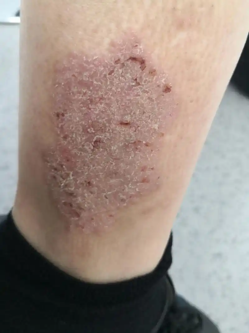 一侧小腿斑块状湿疹症状.#湿疹#