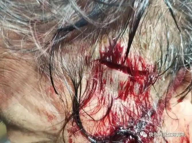 孩子头部撞伤要不要去医院