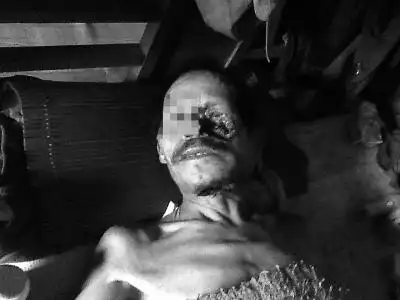 老汉面部溃烂脸现大洞似虫蚀如生化怪人图