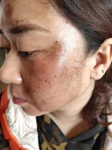 真皮斑的全过程