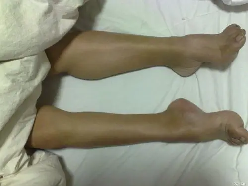 右大腿,腓肠肌有萎缩