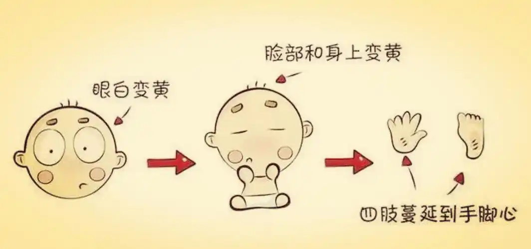 新生儿黄疸可轻可重,这些悲剧要引以为戒!