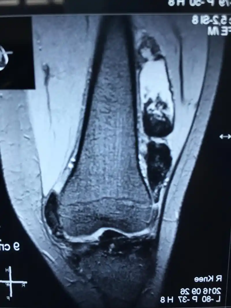 年轻人的膝关节积液原因之一:绒毛结节性滑膜炎 - 好大夫在线