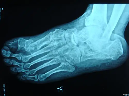第一跖骨陈旧性骨折畸形愈合 - 骨科专业讨论版 -丁香园论坛