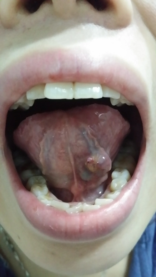 你好医生我舌头下面长了一个很大的肉疙瘩很小的时候就有以为