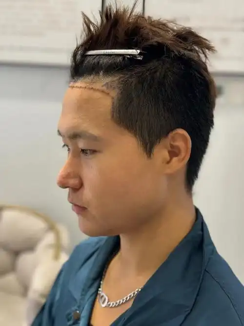 熙朵植发##植发效果##植发效果反馈##植发