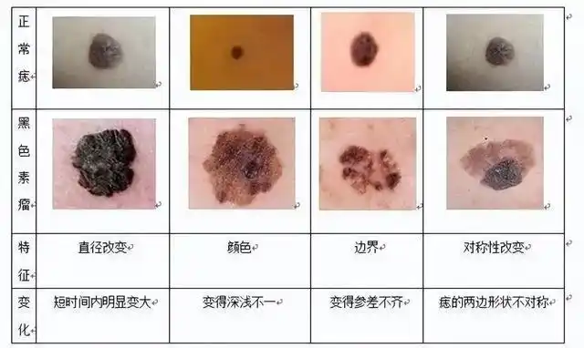 豫健科普这3个部位的痣或与癌症相关