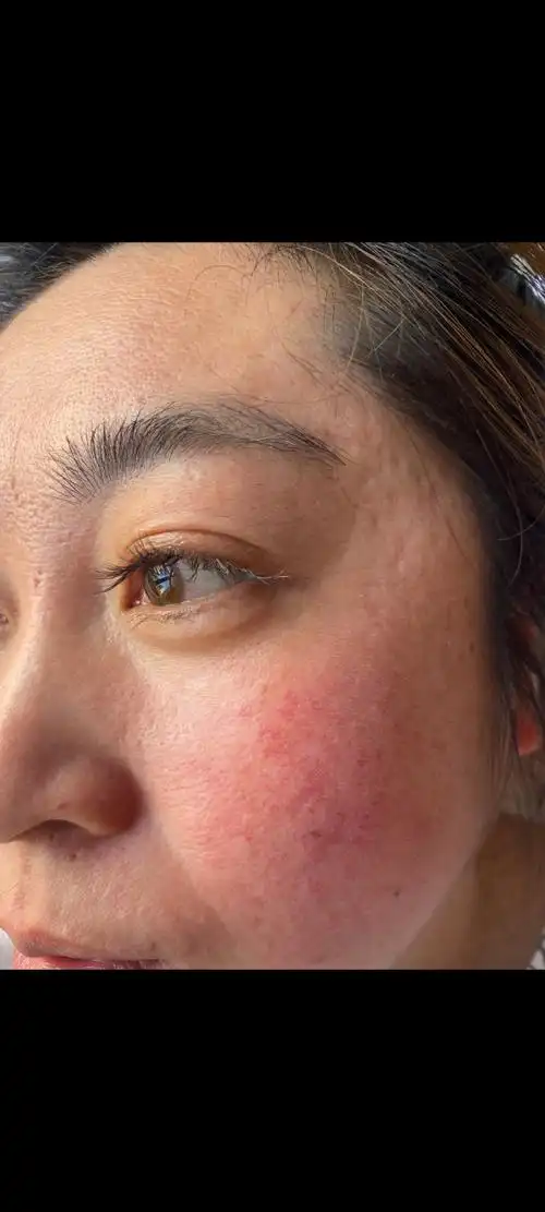 20多年敏感肌肤大红脸,一次修复的效果