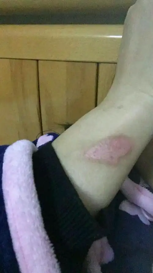 烫伤了,怎样会不留疤_百度知道