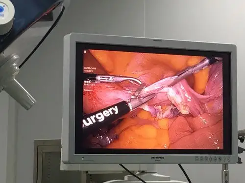 我院妇科腹腔镜下子宫全切除术        腹腔镜技术是一种微创手术,它