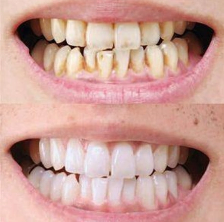 牙齿冷光美白前后对比示意图