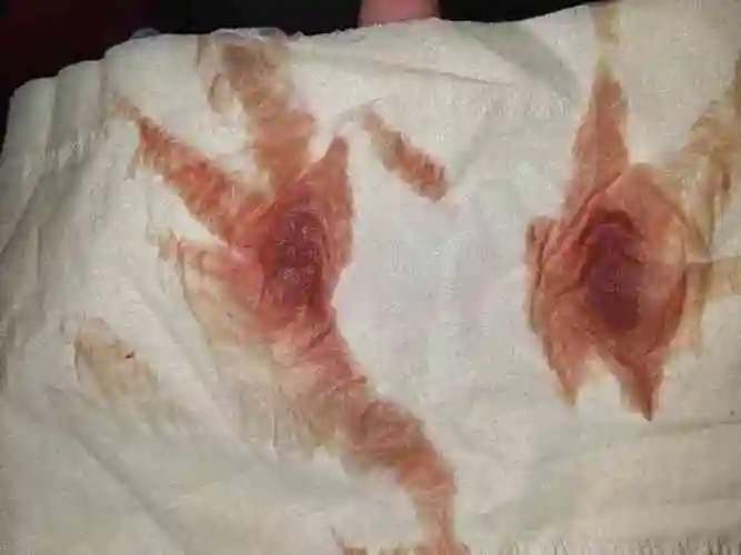 着床出血代表受精卵着床