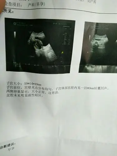 孕40多天胎囊大小,正常吗