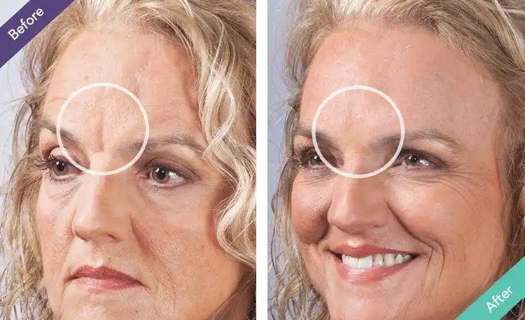 before & after photo-xyz smart collagen reviews