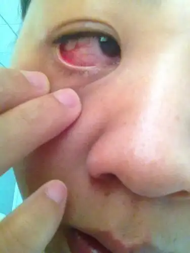 我眼睛前几天眼角膜发炎,满眼都是红血丝,这两天又动不动就出红血丝