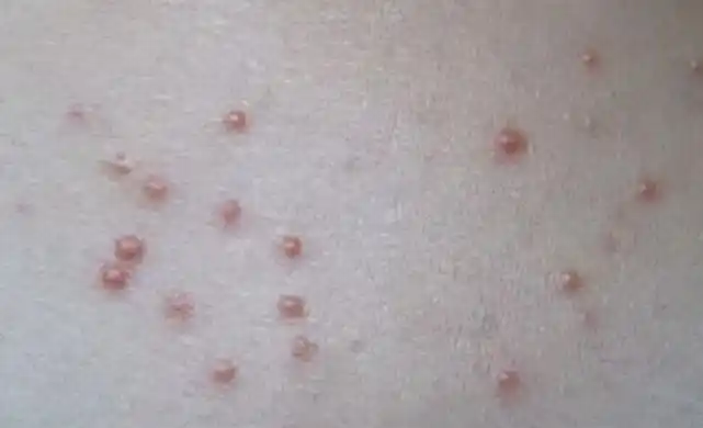 16岁高中生查出hpv,家长怒骂不检点,医生:别冤枉孩子,原因在你们_病毒