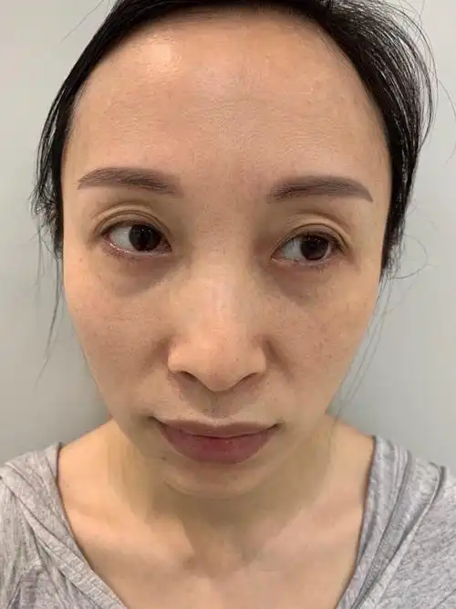 我上眼皮的皮肤特别松弛,很显老,而且很不喜欢那么多_圈子-新氧美容