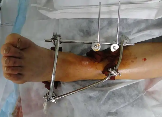 一例胫腓骨远端粉碎性骨折