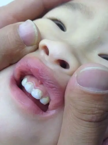 宝宝一岁半从一个月前发现大门牙靠近牙龈的地方像腐蚀了一样,孩子从