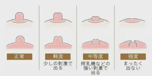 女性的乳头凹陷是怎么回事?每个女孩子的咪咪都不一样吗?_网易订阅