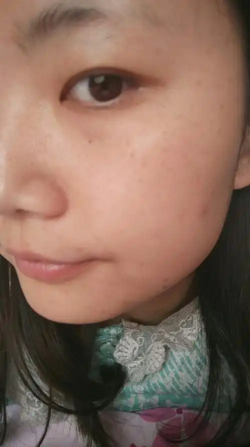 求助,脸上,眼睛周围都有很多斑,不知怎么破?