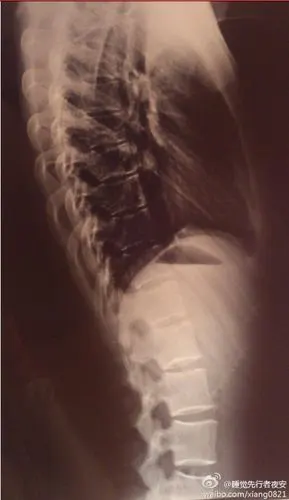 有骨科或者学医的童鞋么?腰伤问题