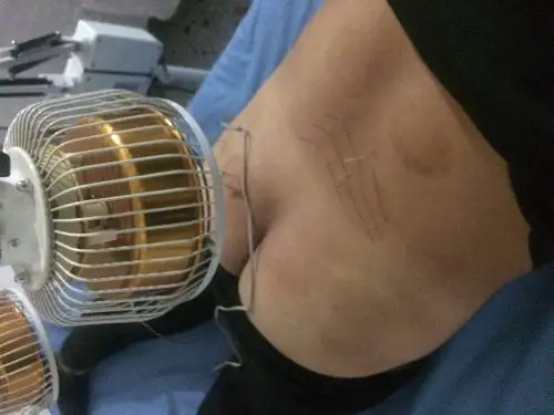 腰间盘突出图片大家进来看看是什么原理