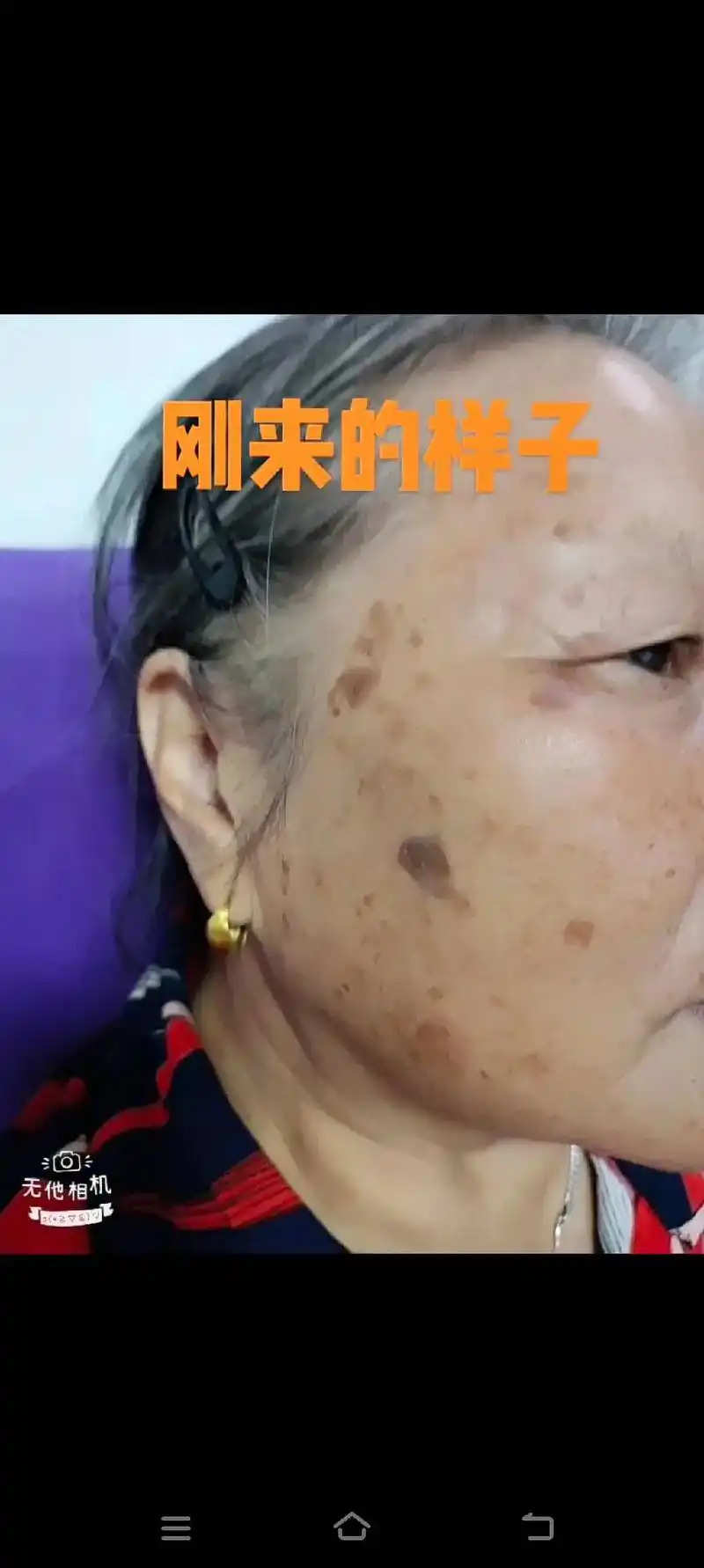 从满脸的老年斑开始.经过半个月的时间修复.又白又嫩的皮肤,你 - 抖音