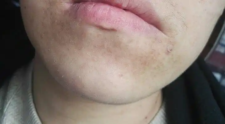 皮肤不好,下巴周围有好多类似斑点的东西,请问这是什么啊?怎么下去啊.