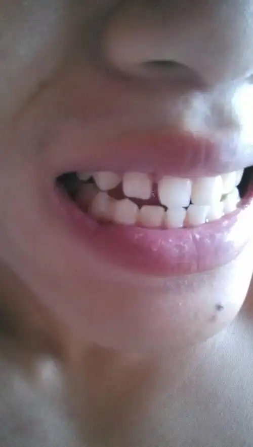 这样的牙缝能整吗,大概要多少钱,我已经19岁了,不知道工作以后能牙齿