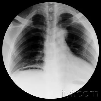 弱弱的问问胃肠穿孔x线怎么看