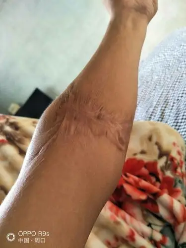 的疤痕不知道到时候能不能当兵有没有好办法谢谢你们了帮帮我想想办法