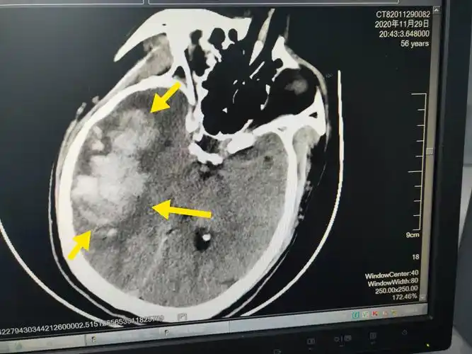 脑出血ct影像学预警识别再出血的征象