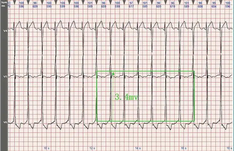 心电图病例分析:左心室肥大(2)