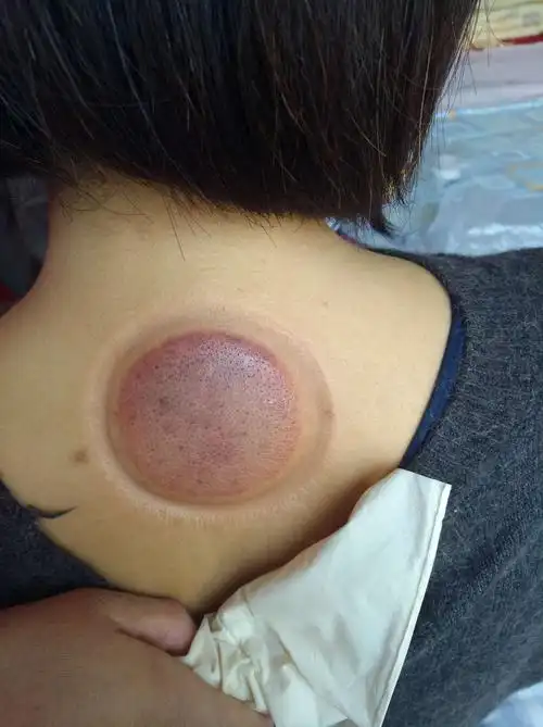 拔罐第一天