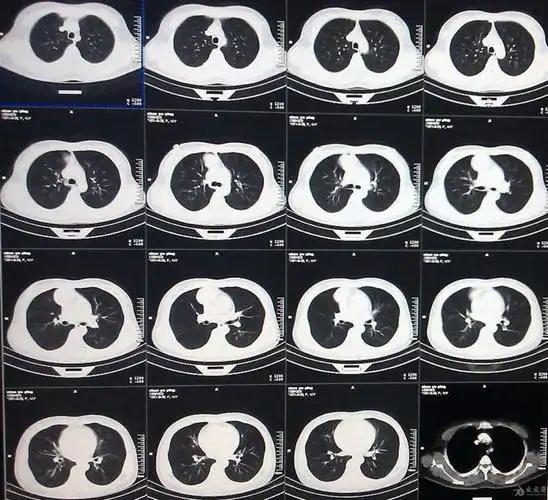 肺结节目标检测一根烟上热搜先让ai看看你的肺
