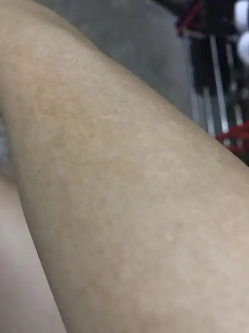 这是汗斑么,长在胳膊上尴尬啊
