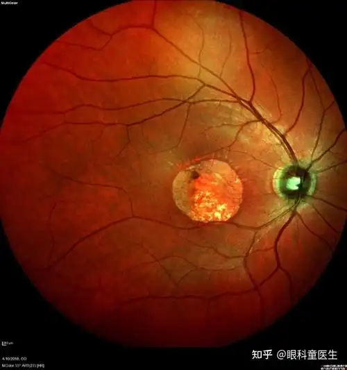脉络膜的变性与营养不良性疾病1中心性晕轮状脉络膜营养不良