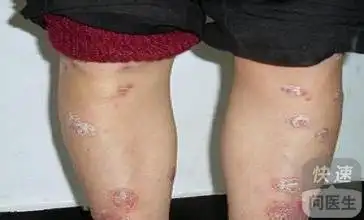 皮肤癌会死吗和治疗皮肤癌方法