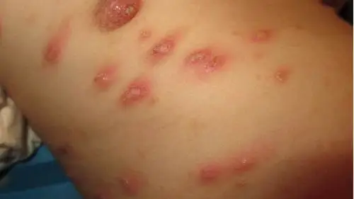 疥疮结节图片 (7)