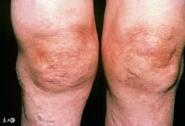 什么是滑膜炎,什么是积水?