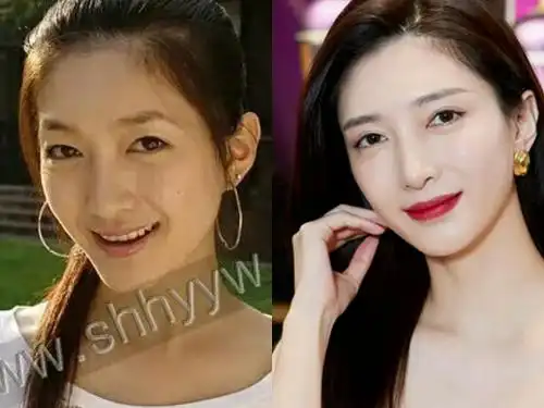 盘点割过双眼皮的明星