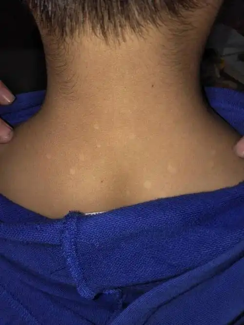 背上白色圆点,不同也不痒,最近才发现的,听说是汗斑,怎么让它消失?