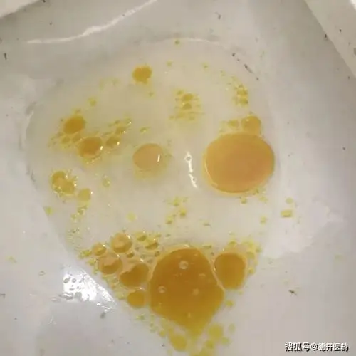 常见的副作用:引起油性便或油性斑点便,胃肠胀气,腹部不适,大便紧急感