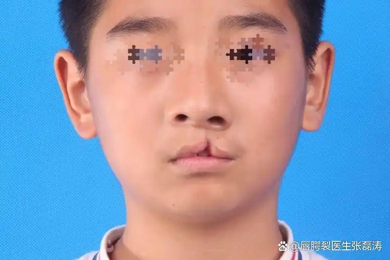 什么是先天性唇腭裂?是指上唇或上腭出现裂口的一种口腔畸形!