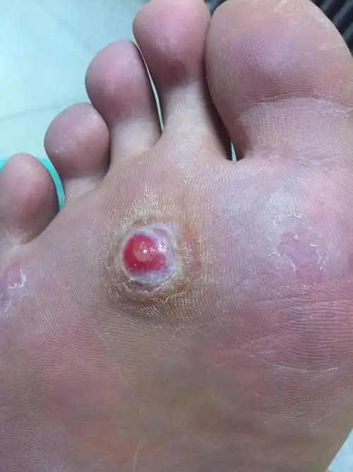 关于鸡眼的问题