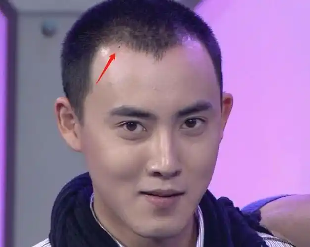 面相发际线上有痣的3种男人第2种事业不顺第1种感情波折
