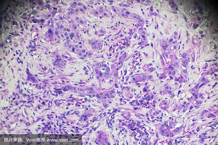 肝细胞癌,显微镜下的hcc