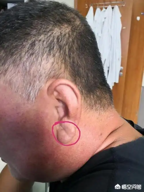 耳朵上有冠心沟就是冠心病的征兆吗