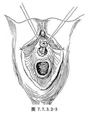 【尿道肉阜环切除术】尿道肉阜环切除术手术详细步骤,尿道肉阜环切除